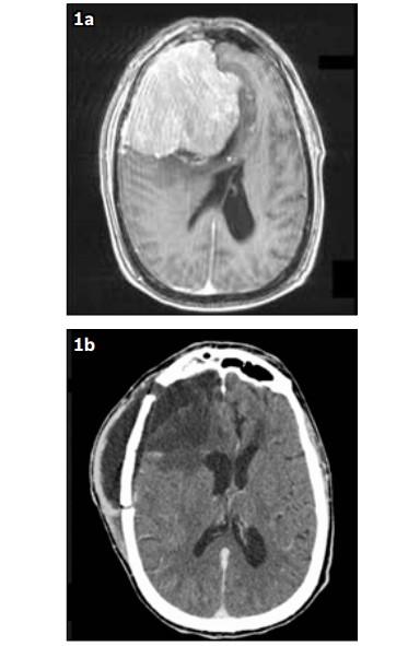 (a) MR image of the brain shows a 7.5 cm × 7.4 cm mass involving the right frontal area, suggestive of a giant meningioma. (b) CT image of the brain shows complete removal of the tumour.